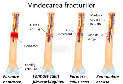 tratamentul articulației brațului fracturilor